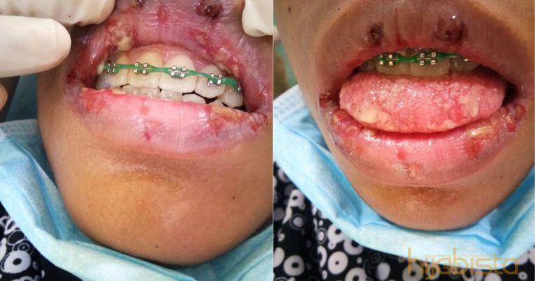 Akibat Fake Braces, Mulut Gadis Ini Tak Boleh Dibuka Kerana Penuh Dengan Air Liur Pekat Nanah