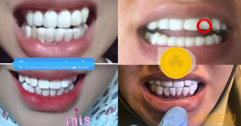 Jangan Percaya ‘Fake Veneer’ Di IG, Lelaki Ini Dedah Bahayanya Hingga Tak Boleh Mengunyah!