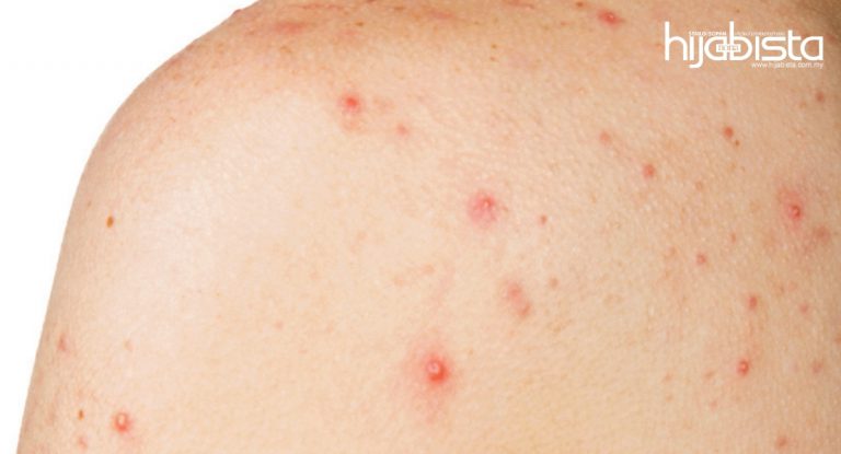 Jerawat Tumbuh Belakang Badan, Boleh Murung Kalau Tak Dirawat. 8 Tip Mudah Untuk Hijabi Atasinya Tanpa Pening Kepala
