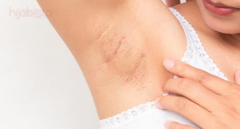 Ketiak Tampak Mulus, Bersih Tanpa Iritasi Boleh Diperoleh Dengan Mudah. Ini 6 Cara Hasilnya Tanpa Tinggalkan Kesan Hitam.