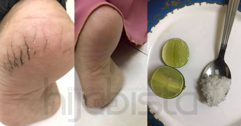 Video Viral Ini Ditonton Lebih 2 Juta, Cuma Tunjukkan Cara Cerahkan Tumit Kaki Merekah Tak Sampai 5 Minit