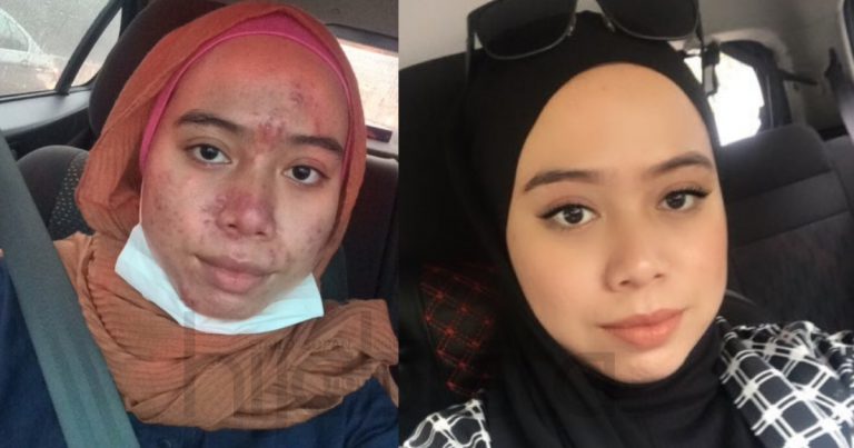 Akibat Guna Produk Lokal, Muka Gadis Ini Rosak Teruk Sebelum Akhirnya Pulih Lepas Ikut 4 Cara Ini