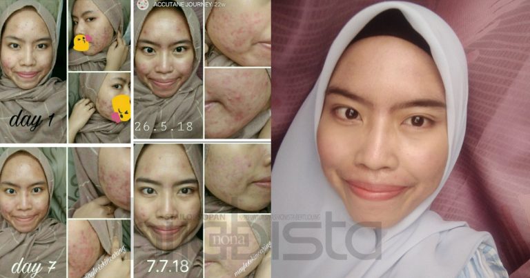 Pernah 2 Kali Alami Breakout, Akhirnya Wajah Gadis Ini Pulih Lepas 7 Bulan Guba Ubat Diberikan Doktor