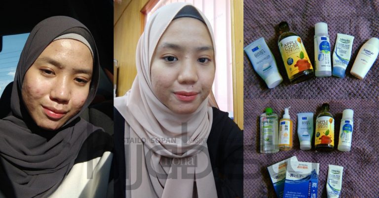 Bertahun Alami Breakout Sampai Malu Nak Jumpa Orang, Akhirnya Gadis Ini Pulih Lepas Guna 10 Produk