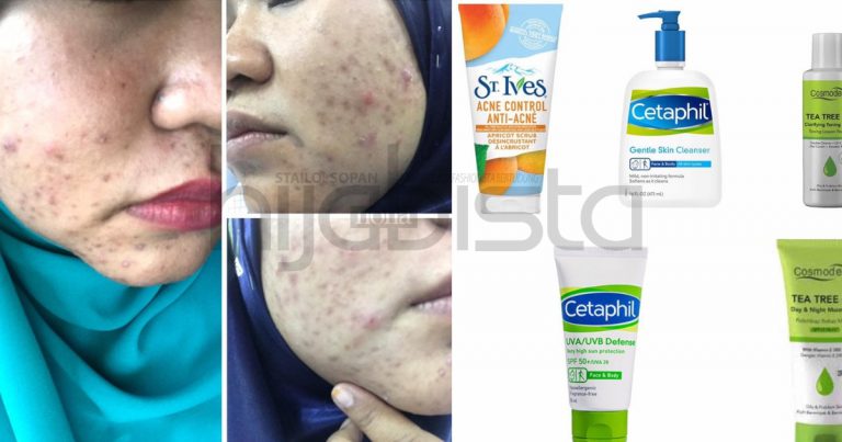3 Kali Alami Breakout, Wajah Wanita Ini Akhirnya Jadi Flawless & Pinky Lepas Setahun Guna Produk Drugstore