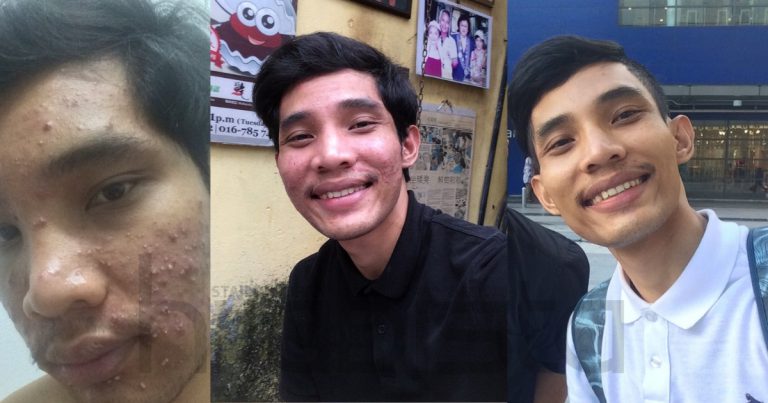 Modal Hanya RM7, Masalah Breakout Dialami Lelaki Ini Akhirnya Pulih & Wajah Pun Jadi Flawless!