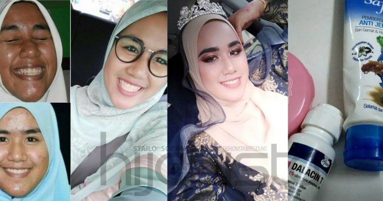 Wajah Pernah Menggerutu Sebab Breakout, Penampilan Gadis Ini Di Majlis Kahwinnya Memang Mengejutkan