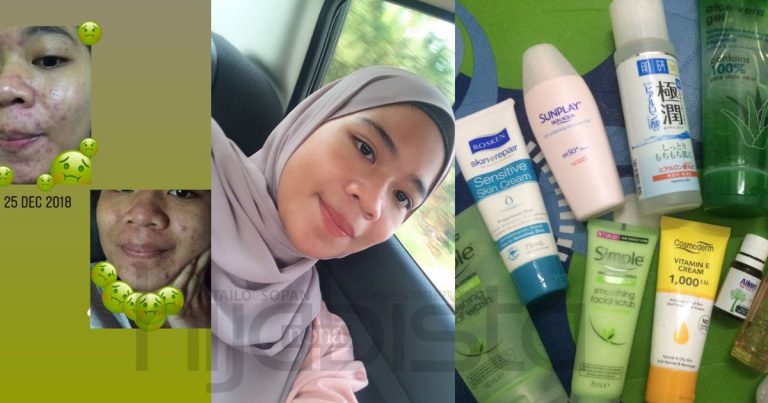 Rawat Wajah Tanpa Skip Guna 12 Produk Drugstore, Gadis Ini Akhirnya Pulih Dari Masalah Breakout