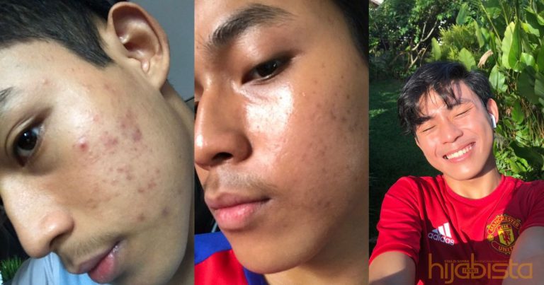 Lebih 8k Retweet, Lelaki Ini Dedah Cara Bagi Pulihkan Kembali Kulit Yang Breakout Teruk