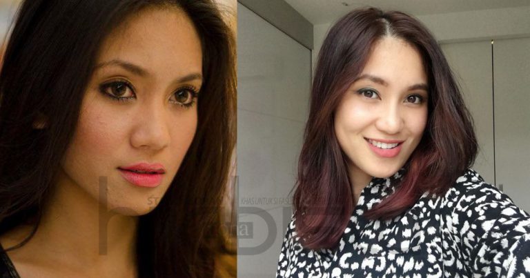 “Rasa Macam Nak Kikis Muka” – 3 Tahun Ramona Zamzam Suffer, Sebelum Wajah Pulih Guna 13 Cara Ini