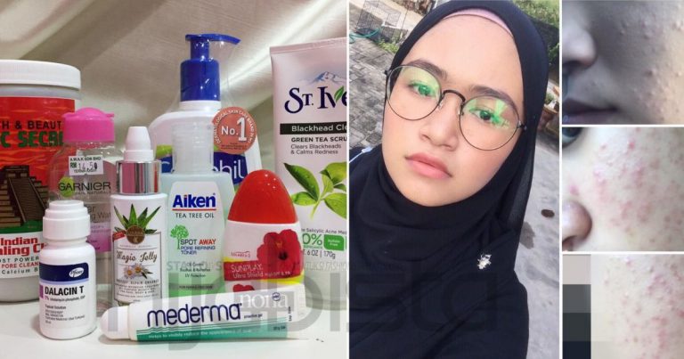 Alami Breakout Lepas Guna Produk Lokal, Gadis Ini Berjaya Pulihkan Wajah Guna Produk Dari Drugstore