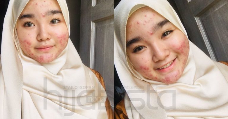“Jerawat Merah Tu Blusher Asli”- Gadis Ini Rileks Je Beraya Dengan Wajah Breakout. Netizen Puji Cantik!