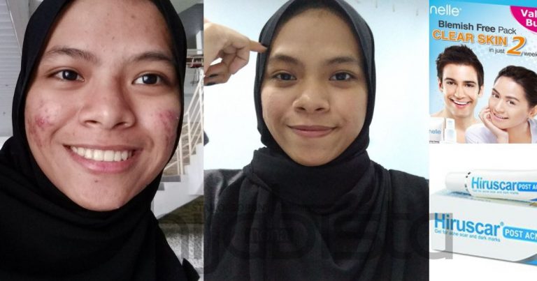 Setahun Gadis Ini Survive Wajah Breakout, Akhirnya Pulih Lepas Ubah Gaya Hidup Guna Produk Serasi