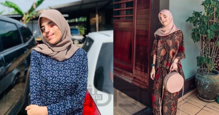 “Kalau Orang Pandang Pelik, Keluarga Pesan Jangan Layan…” Gadis Istimewa Ini Yakin Bergaya Walau Diri Kekurangan
