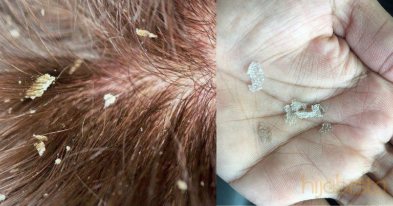 Gadis Ini Saran Syampu Terbaik Untuk Atasi Masalah Kelemumur Berkuping. Memang Berkesan!