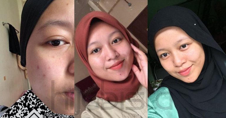 Rahsia Guna Produk Lepas 2 Bulan, Kulit Wajah Gadis Ini Kini Bebas Dari Masalah Muka Kemerahan. Hasilnya WOW!