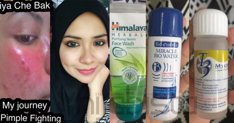 Pernah Dihina Wajah Bermasalah ‘Breakout’ Teruk, Gadis ini Kongsi Rawatannya Guna Produk Bersesuaian