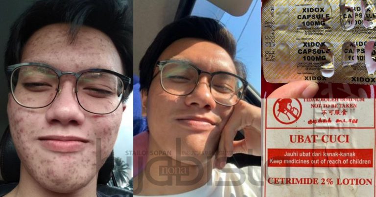 Lepas 7 Bulan Lelaki Ini Berjaya Pulihkan Wajah Dari Breakout. Guna Ubat Hospital & Bajet Serendah RM5 Je!