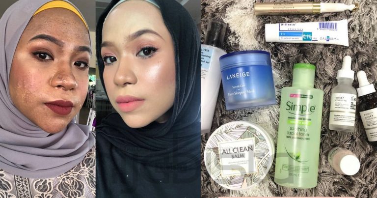 Setelah Bertahun Wajah Berjerawat, Wanita Ini Akhirnya Berjaya Pulih Tak Sampai Sebulan Lepas Ikut Cara Ni