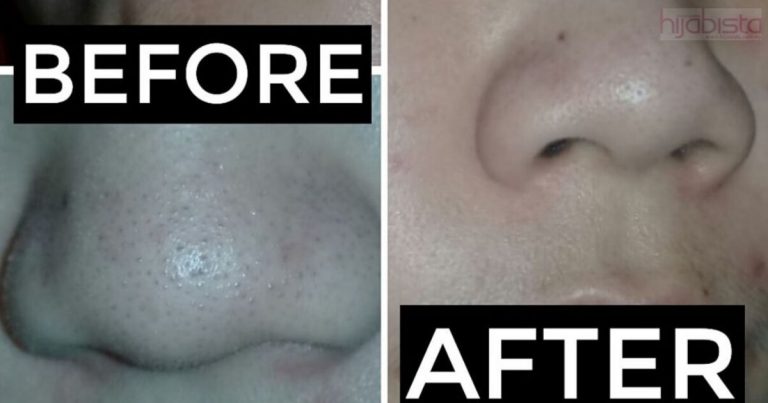 Hidung Berbintik Hitam Macam Kertas Pasir Boleh Jadi Licin Macam Kain Satin, Ini Caranya