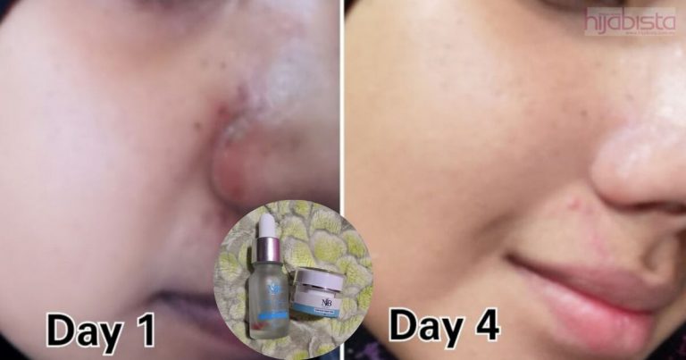 Wanita Ini Kongsi Macam Mana Nak Rawat Kayap Yang Menjalar Pada Wajah