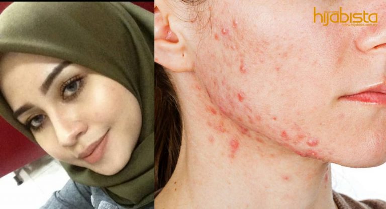 Ribuan Ringgit Melayang Semata-Mata Nak Hilangkan Kesan ‘Breakout’, Bertahun Istiqomah Guna Produk Tempatan.