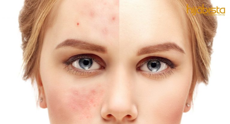 Ketahui Jenis Jerawat Sebelum Merawatnya. No 4 Jangan Ambil Mudah!