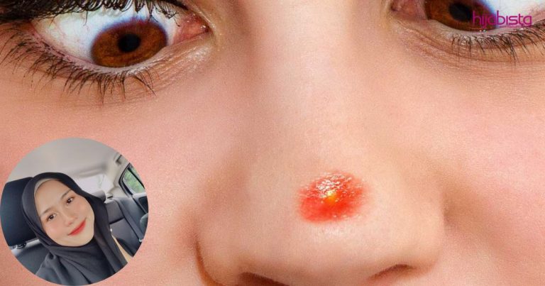 Sapu Aloe Vera Gel RM5 Je,  Jerawat Merah Jadi Surut Dalam Masa Tiga Hari