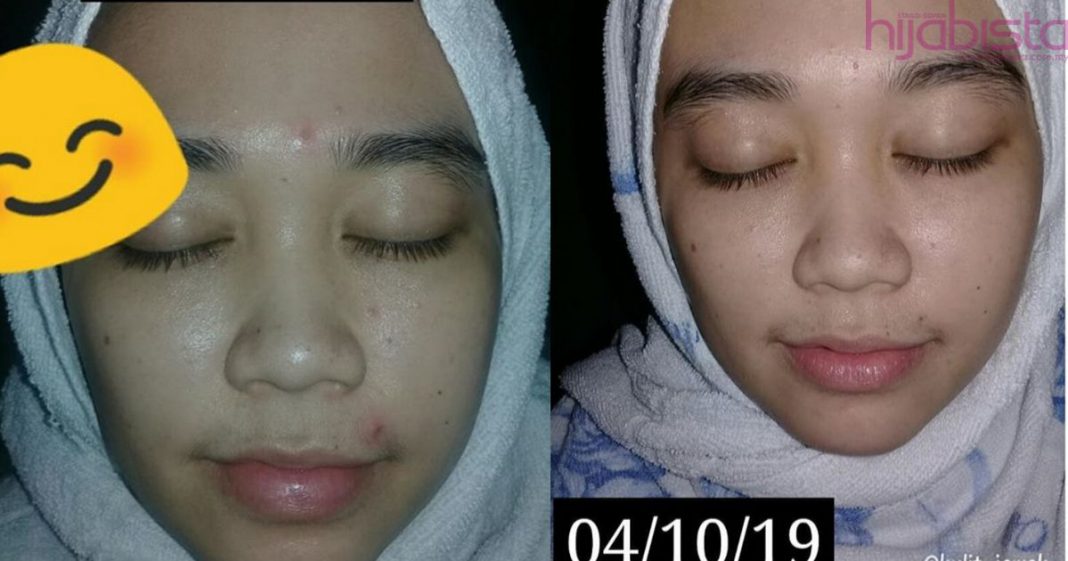 Rasa Geram Bila Tiny Bumps Muncul Di Wajah, Gadis Ini