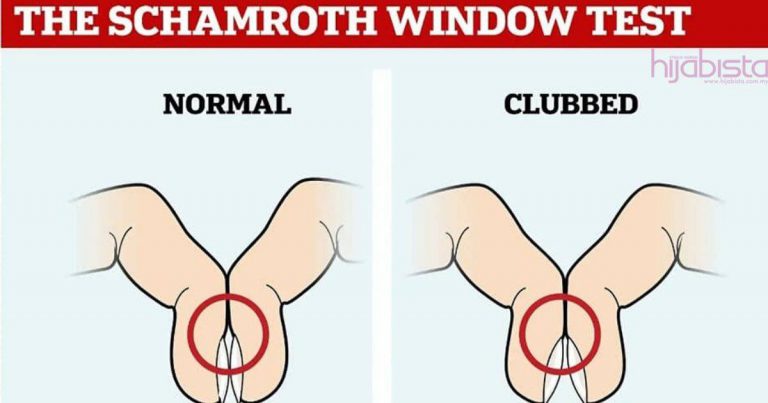 Bukan Remeh! Ujian 2 Jari Telunjuk Ini Beri Tanda Anda Hidap Kanser Paru-Paru Atau Tidak