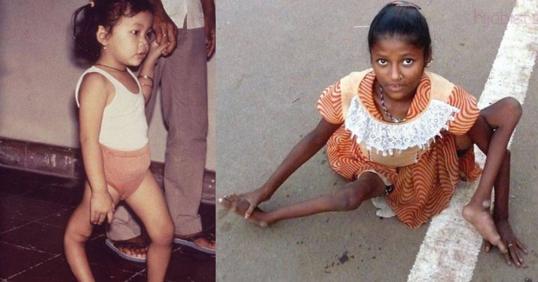 Boleh Jadi Lumpuh, Doktor Ini Jelaskan Tentang Virus Polio Dengan Cara Paling Simple