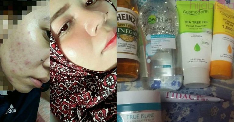 Gadis Ini Kongsi Cara Paling Berkesan Bagi Hilangkan Jerawat Halus, Parut & Kecilkan Pori Wajah