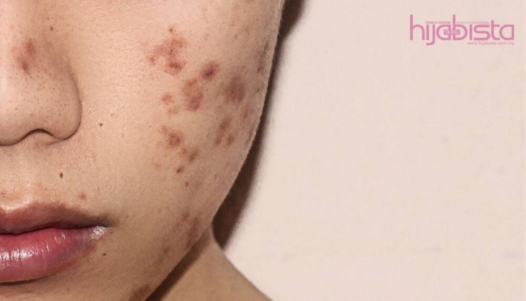 Bekas Jerawat Yang Ditakuti, Kenali Penyebab, Cara Mengatasi, Plus Cara Mencegahnya. Take Note Sis!