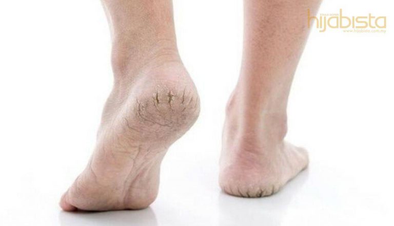 Kaki Merekah & Keras, Ini Cadangan Foot Mask Terbaik Untuk Kaki Selembut Bayi
