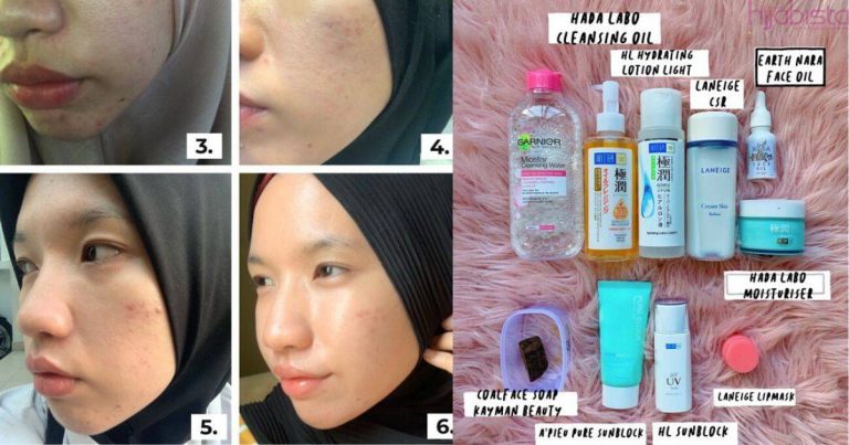 Dahulu Muka Berjerawat Teruk, Gadis Ini Share Rutin Bagi Wajah Kembali Flawless