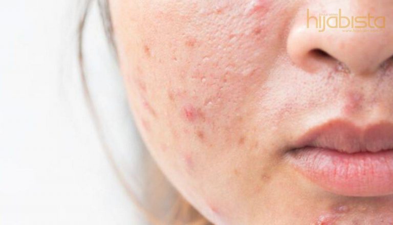 8 Cara Mudah Hilangkan Kesan Kemerahan Di Wajah Tanpa Penggunaan Bahan Kimia. Dijamin Selamat!