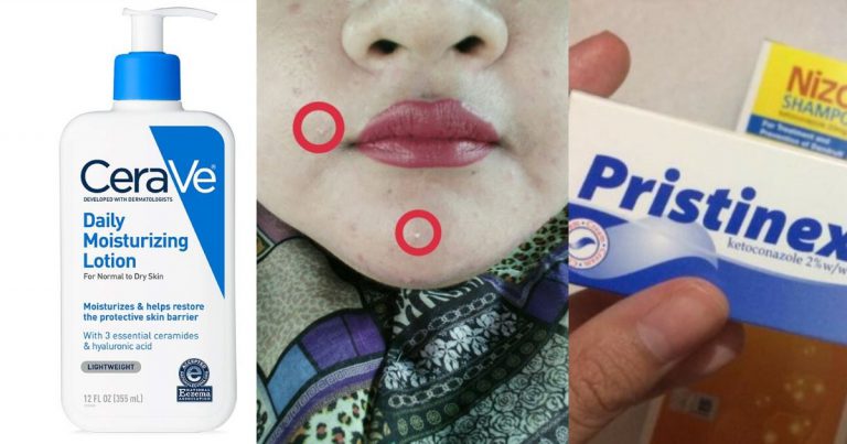 Bukan Jerawat Biasa, Gadis Ini Kongsi Tip Merawat Fungal Acne Yang Menyebabkan Kegatalan