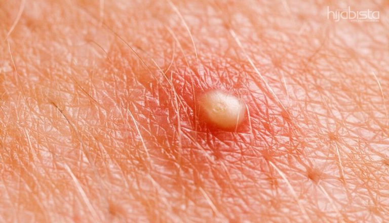 Jerawat Tumbuh Melata di Punggung, Ini 5 Cara Mudah Merawat.