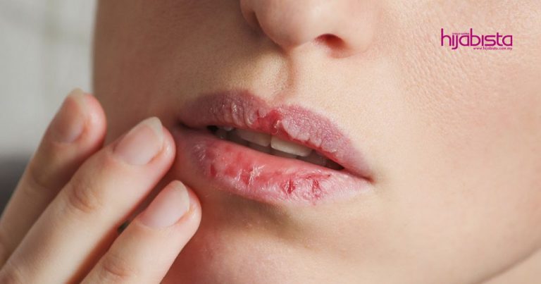Wanita Ini Kongsi Tip Elak Bibir Kering Dan Merekah Ketika Berpuasa