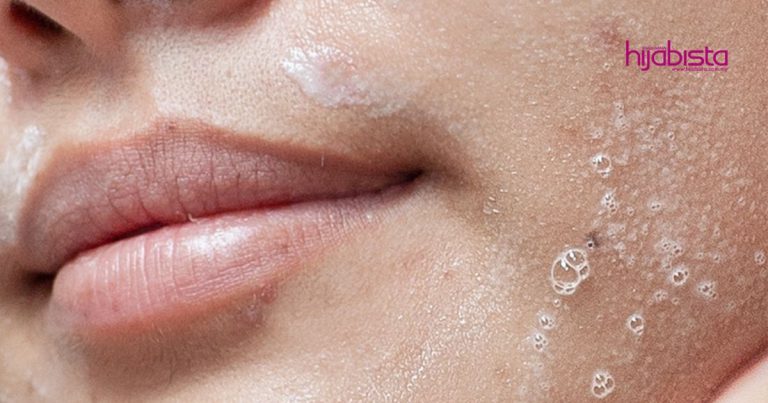 Krim Paling Best Untuk Cepat Kecutkan Jerawat, Bajet Bawah RM30