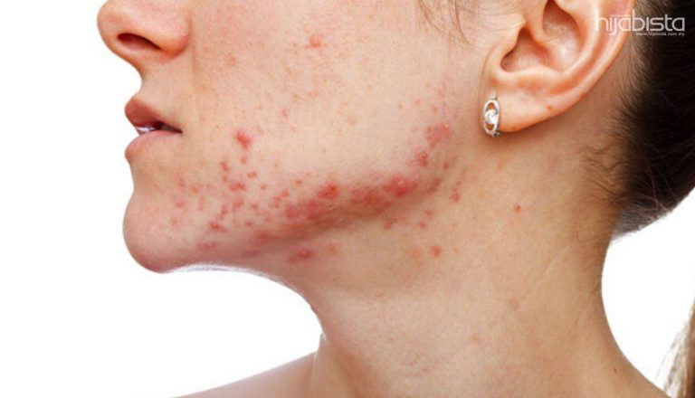 Jerawat Tumbuh di Leher, Yang Berhijab Awas Ini Punca & Cara Atasinya
