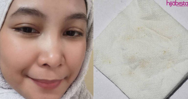 Blackhead Terus Hilang Bila Ikut Teknik ’15-5′ Ini. Puas Hati Tengok Semuanya Keluar Dari Muka!