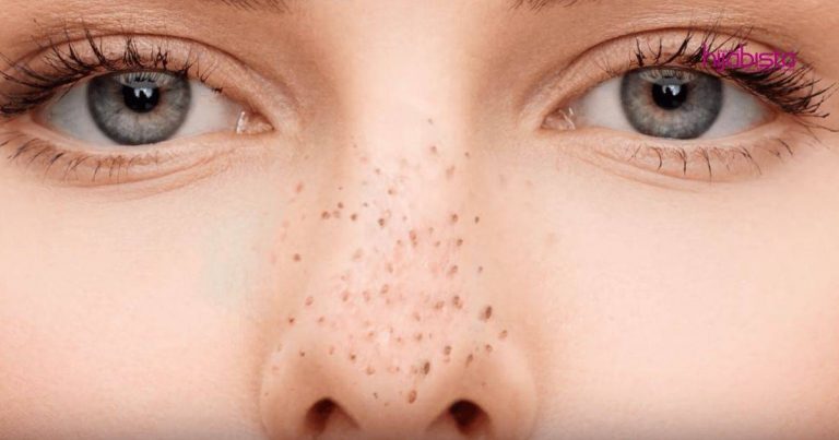 Hilangkan Whitehead & Blackhead Tanpa Pergi Spa, Hasilnya Lebih Cepat, Mudah & Murah