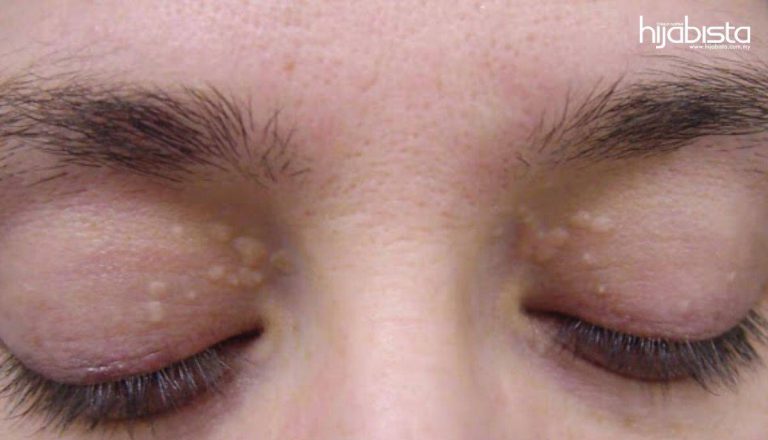 . “Jerawat Nasi” Kutil Yang Berwarna Putih, Bukan Jerawat. Itu Tanda Kolestrol Tinggi Dalam Badan. Ini Puncanya!