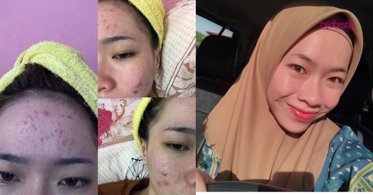Gadis Ini Share Cara Rawat Masalah Breakout Yang Dihadapinya, Dalam Masa 5 Bulan Wajah Pulih