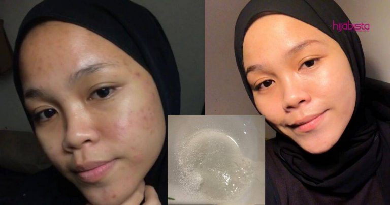 Gadis Ini Kongsi Cara Buat Skrub Hilangkan Parut Jerawat, Hanya Guna Pencuci Muka + Gula Halus