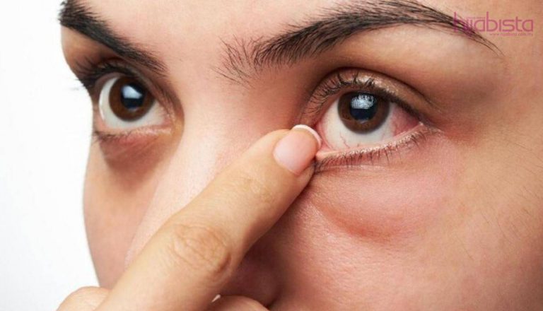 4 Punca Timbulnya Kantung Mata, Ketahui Bagaimana Mengatasinya. Ini Nasihat Doktor!