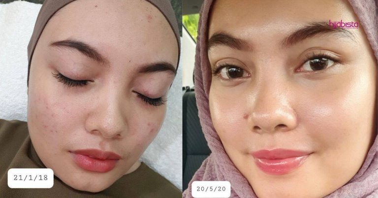Gadis Ini Kongsi ‘Perjalanan’ Rawat Kulit Wajah Berparut & Kusam Sejak 2018 Hingga 2020, Cantik Dah Kulit Dia