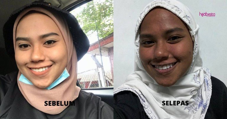 Pakai Sunscreen Pun Kulit Wajah Teruk Sunburn, Tak Tahu Apa Penyebab, Gadis Ini Kongsi Pengalaman