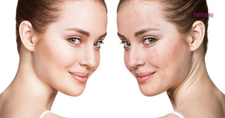 Wanita Ini Kongsi Rutin Kecantikan Rawat Kulit Breakout Khusus Untuk Kulit Kombinasi